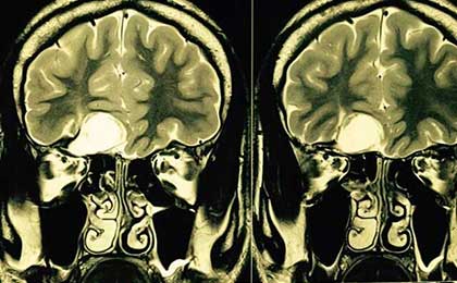 frontal epidermoid pre t2w