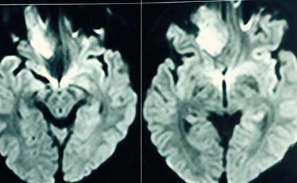 frontal epidermoid pre diffusion