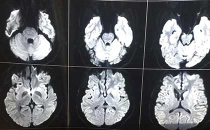 frontal epidermoid post