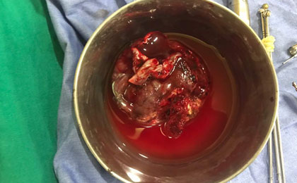 frontal lobe tumor intraop