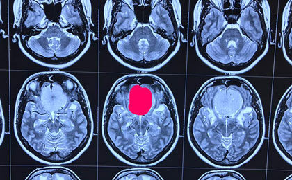 frontal epidermoid pre diffusion