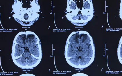 frontal epidermoid post