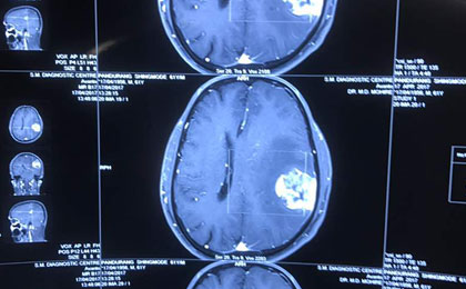 Huge Haemangioma PRE