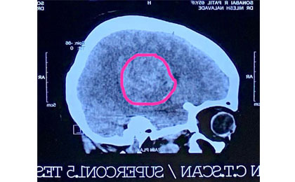 Brain Tumor Surgery  14/02/2019