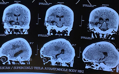 Brain Tumor Surgery  14/02/2019