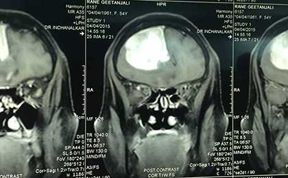Huge Haemangioma PRE