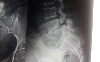 Spine Fixation Lumbar Spine
