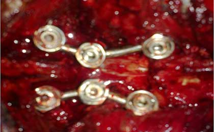 Spine Fixation Lumbar Spine