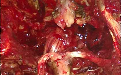 Spine Fixation Lumbar Spine