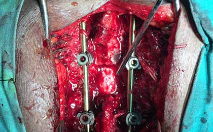 Spine Fixation Lumbar Spine