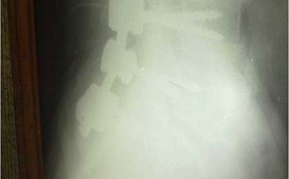 Spine Fixation Lumbar Spine