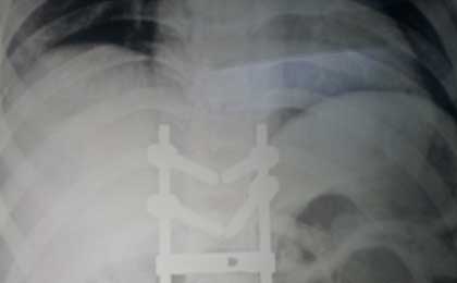 Spine Fixation Lumbar Spine