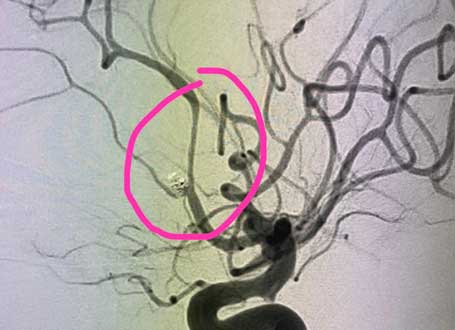 Successfully Done Brain Aneurysm Treatment
