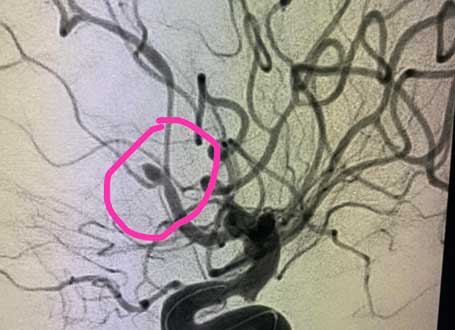 Successfully Done Brain Aneurysm Treatment